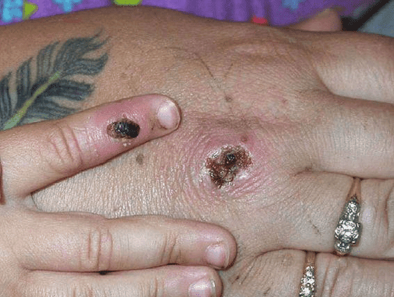 Monkeypox is a rare disease caused by infection with the monkeypox virus (Photo: CDC/Getty Images)