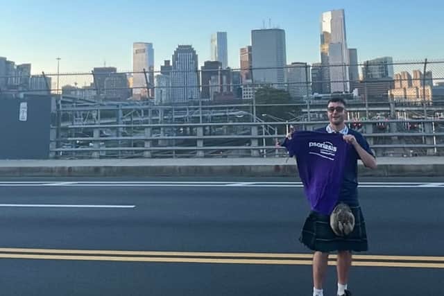 Photo shows Logan Gilmartin posing in Boston with a Psoriasis Association t shirt, wearing a kilt.