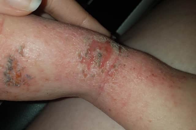 Lukas' skin earlier this year.