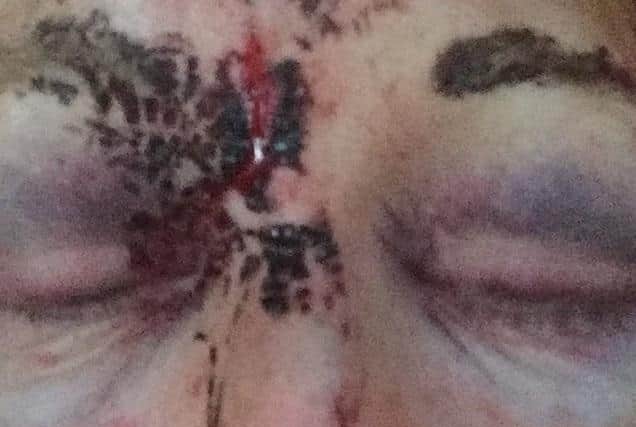Her injuries