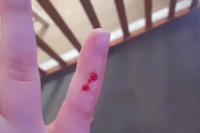 The girl was bitten on the finger.