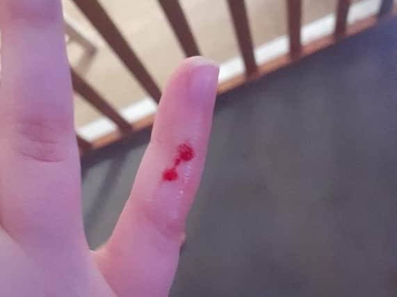 The girl was bitten on the finger.