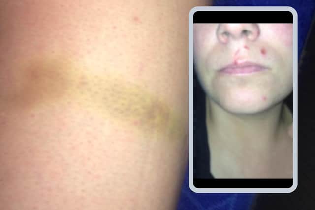 Some of the injuries inflicted on Amanda