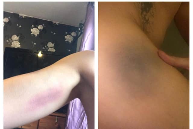 Bruises on Cali's body.