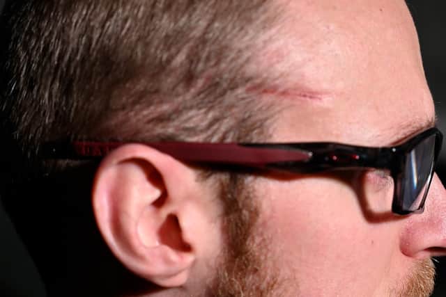 Sgt Cayton's scar.