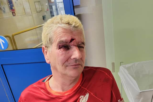 Dave before being stitched up