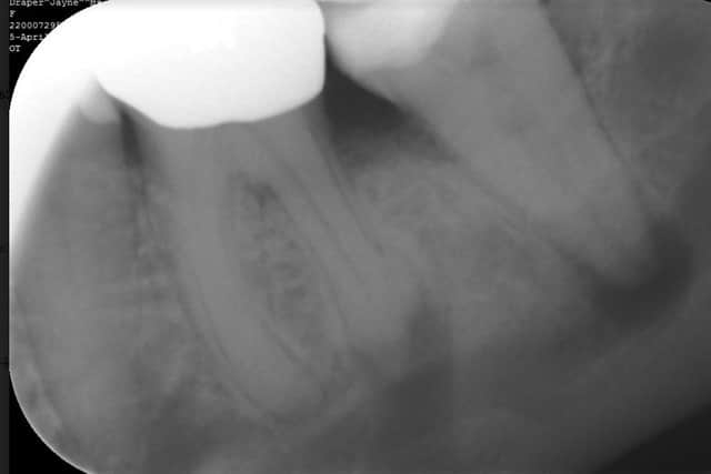 Abscesses at the base of Ms Draper's lower left molars.