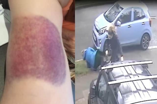 One of Shirley's bruises and the moment she was knocked to the ground.