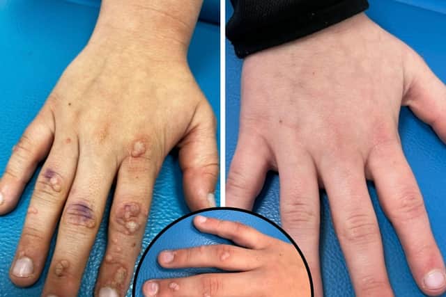 Harry's hand before treatment (left) and after treatment (right)