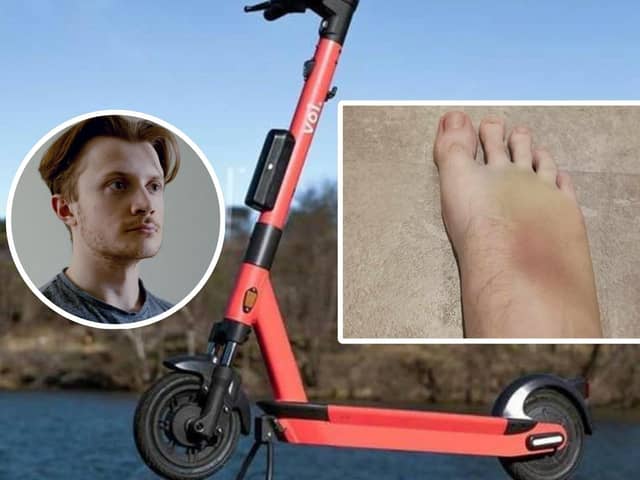 Jordan Sclater/ a Voi scooter/ Mr Sclater's bruised foot/UGC