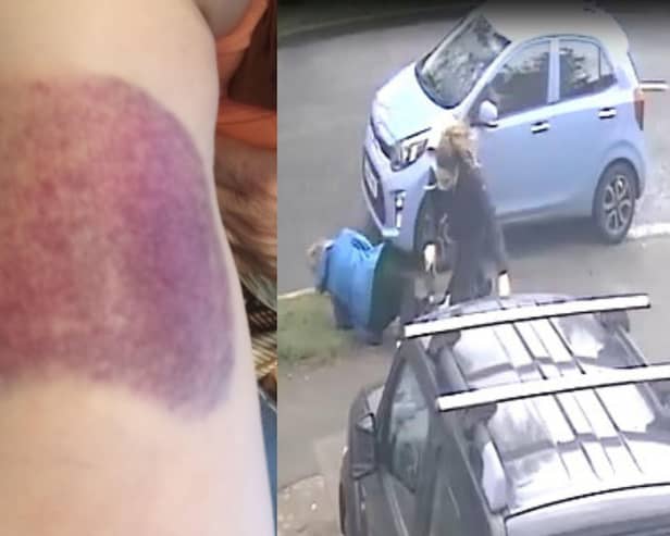 One of Shirley's bruises and the moment she was knocked to the ground