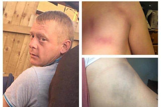 Ashley Gleeson and some of the bruises on Cali's body.