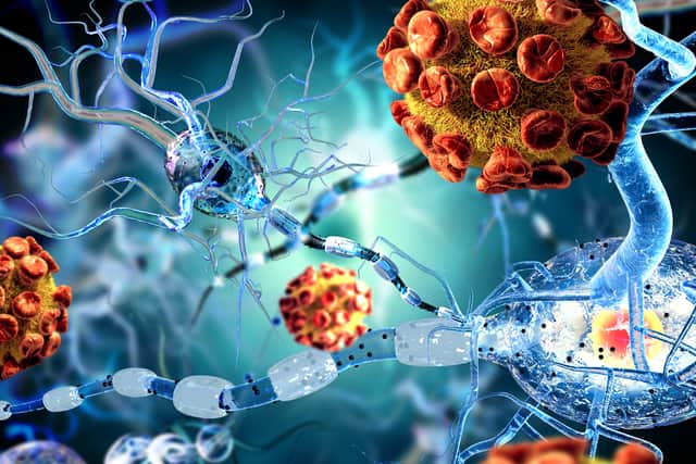 Covid can cause lasting neurological effects including a stutter - everything scientists know so far (Photo: Shutterstock)