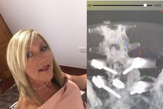 Tracey Watson and a X-ray image of her spine