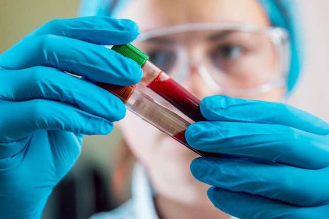 Four in five Britons dont know they have hepatitis B