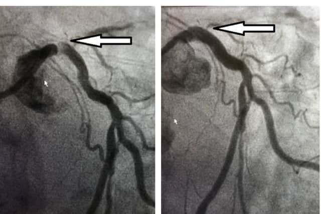 Before (left) and after (right) these x-ray images show how the artery opened up after the procedure NNL-181122-112207005