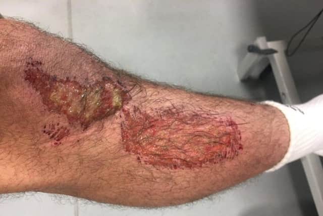 Alex Mitchell suffered leg injuries from playing at Allianz Park (picture: @alexmitchell97)
