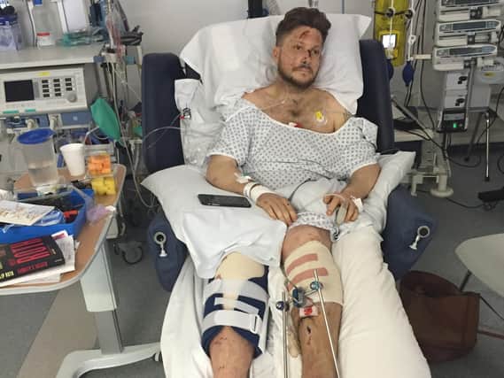 Joe pictured in hospital after his terrifying accident