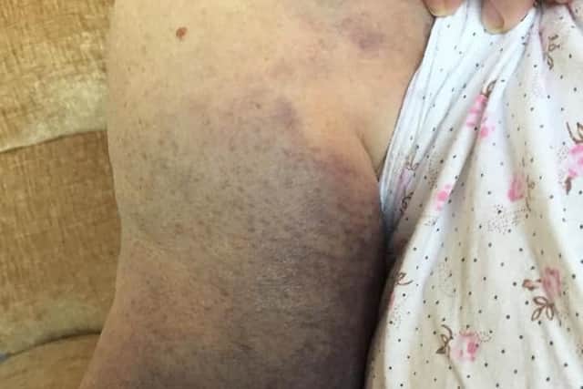 Bruising on Joy Morson's arm caused by the break she suffered when a man stole her handbag