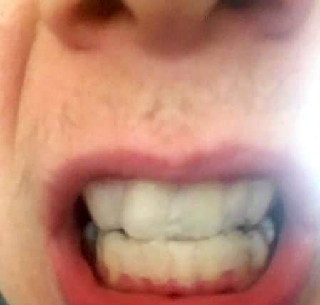 Jake with the whitening strips on his teeth. PICTURE: SWNS