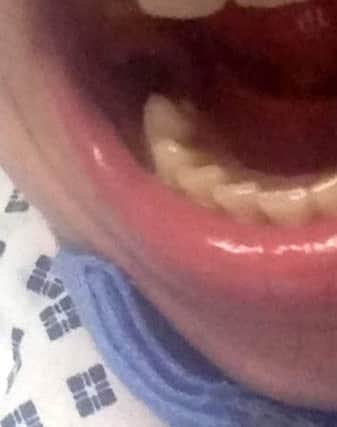 Jake lost a tooth during the ordeal after it became infected