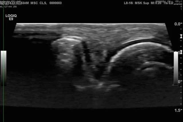 State of the art ultrasound technology has revealed what causes knuckles to "crack" out loud