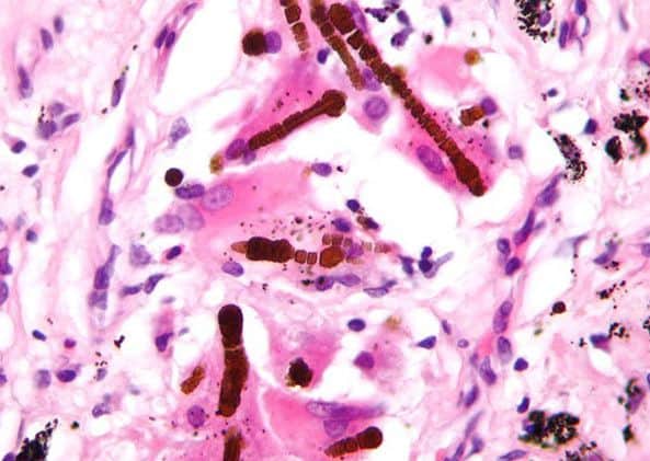 Asbestos exposure can lead to health complications including asbestosis